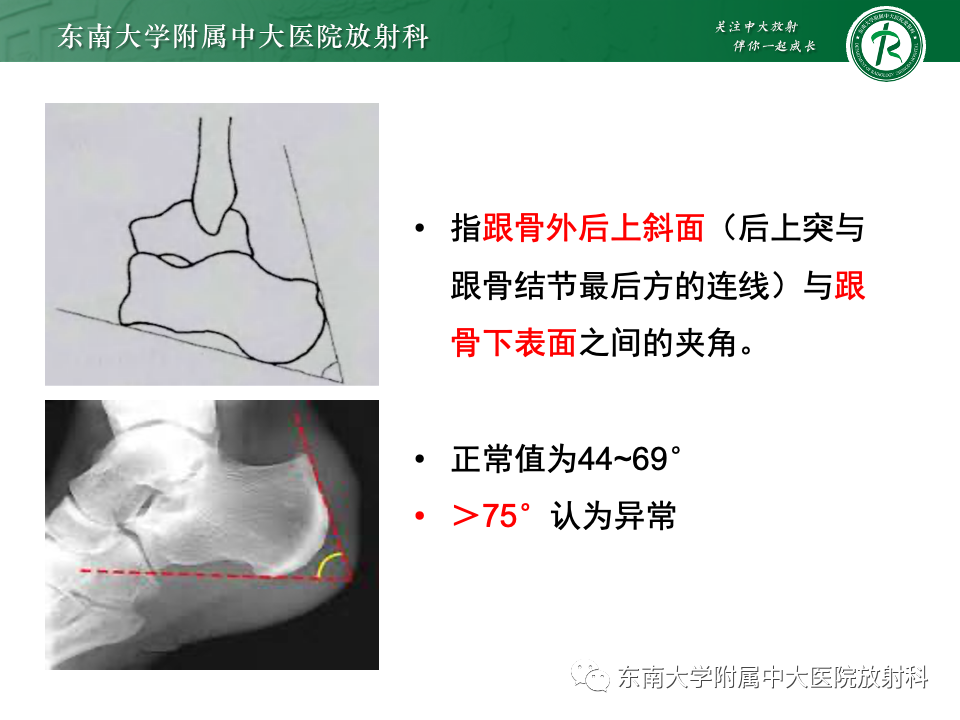 影像PPT - 【PPT】Haglund综合征-21 影像PPT - 【PPT】Haglund综合征-21