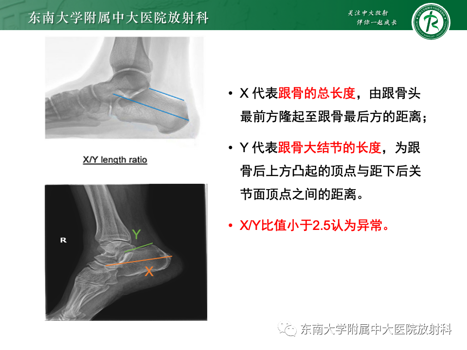 影像PPT - 【PPT】Haglund综合征-25 影像PPT - 【PPT】Haglund综合征-25