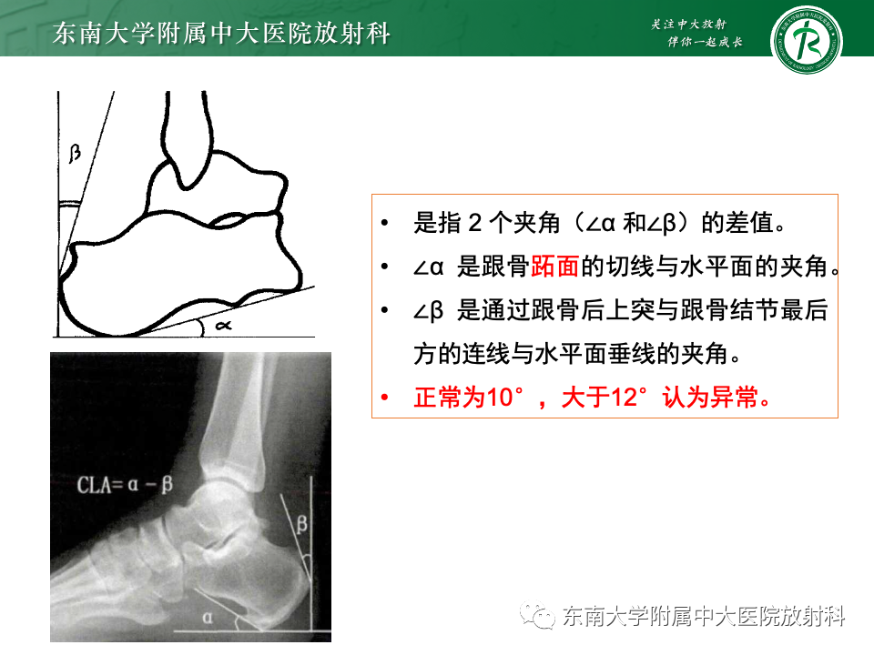 影像PPT - 【PPT】Haglund综合征-23 影像PPT - 【PPT】Haglund综合征-23