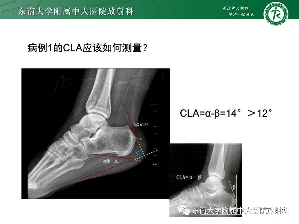 影像PPT - 【PPT】Haglund综合征-29 影像PPT - 【PPT】Haglund综合征-29