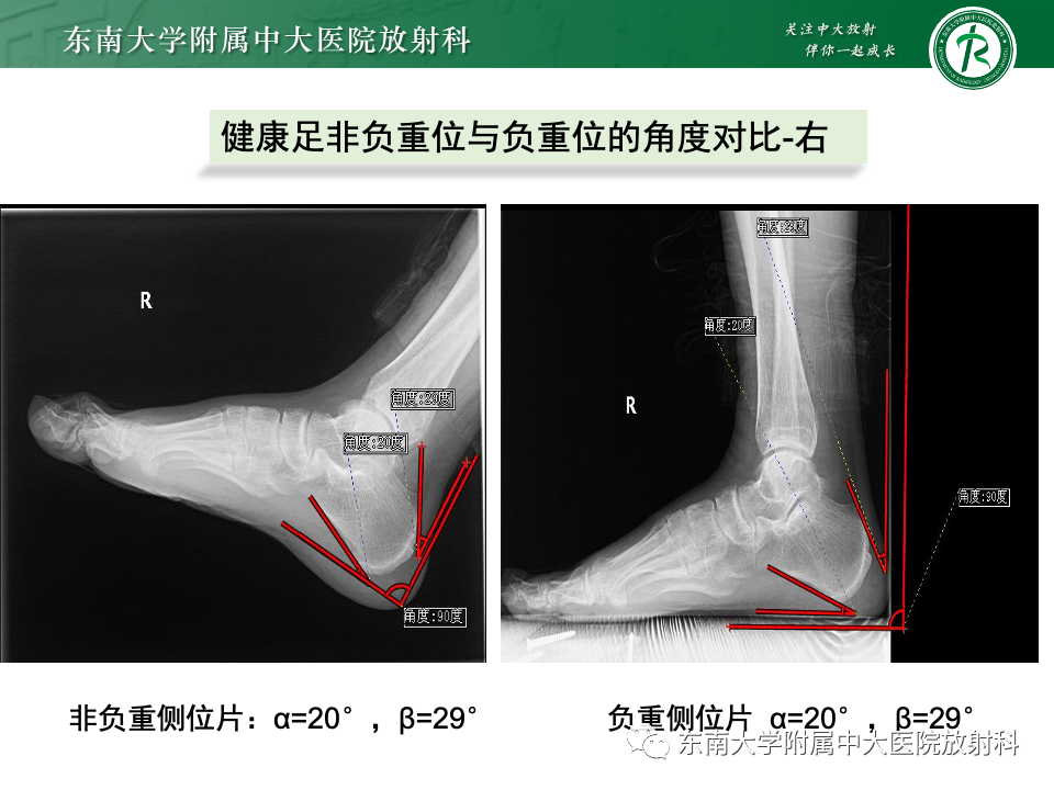 影像PPT - 【PPT】Haglund综合征-30 影像PPT - 【PPT】Haglund综合征-30