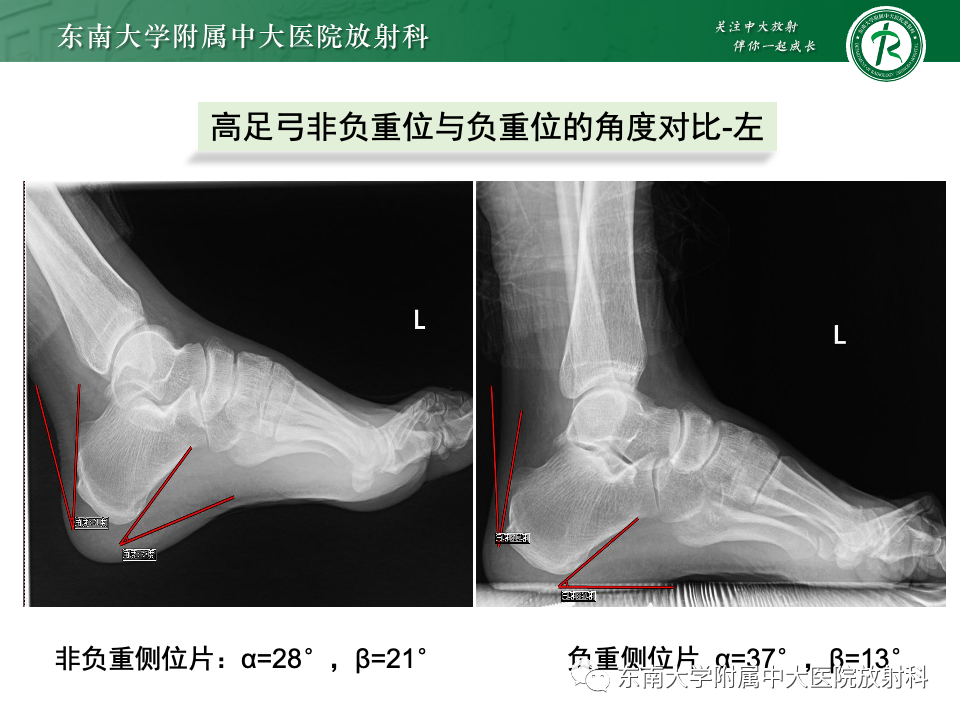 影像PPT - 【PPT】Haglund综合征-31 影像PPT - 【PPT】Haglund综合征-31