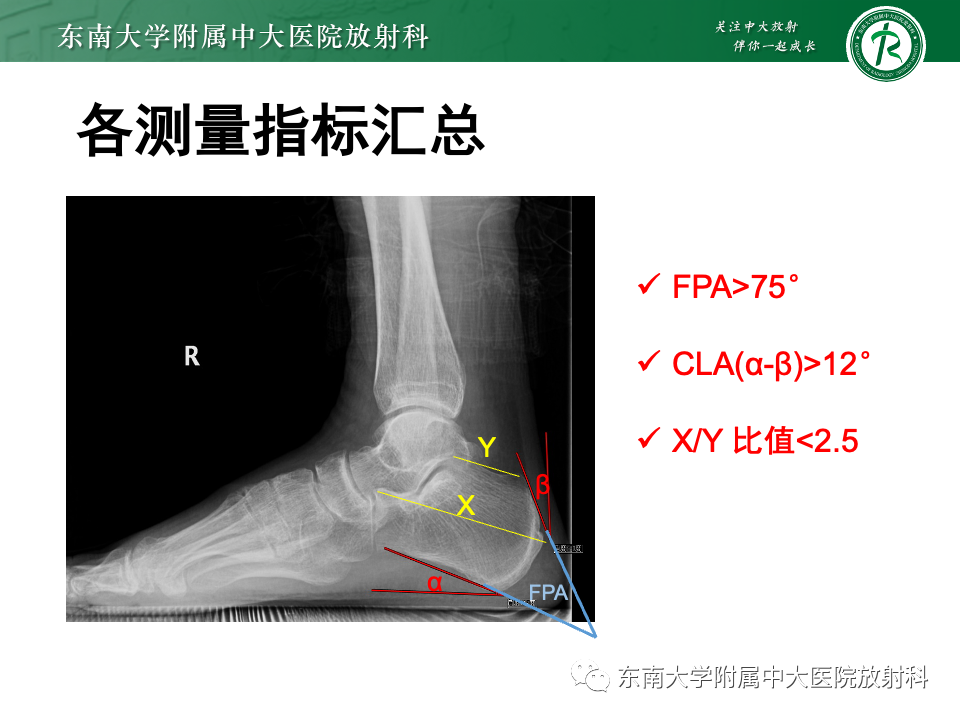 影像PPT - 【PPT】Haglund综合征-32 影像PPT - 【PPT】Haglund综合征-32