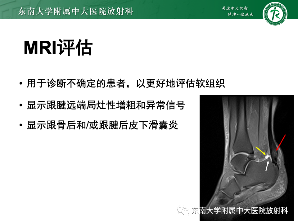 影像PPT - 【PPT】Haglund综合征-34 影像PPT - 【PPT】Haglund综合征-34