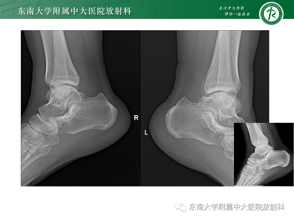 影像PPT - 【PPT】Haglund综合征-39 影像PPT - 【PPT】Haglund综合征-39