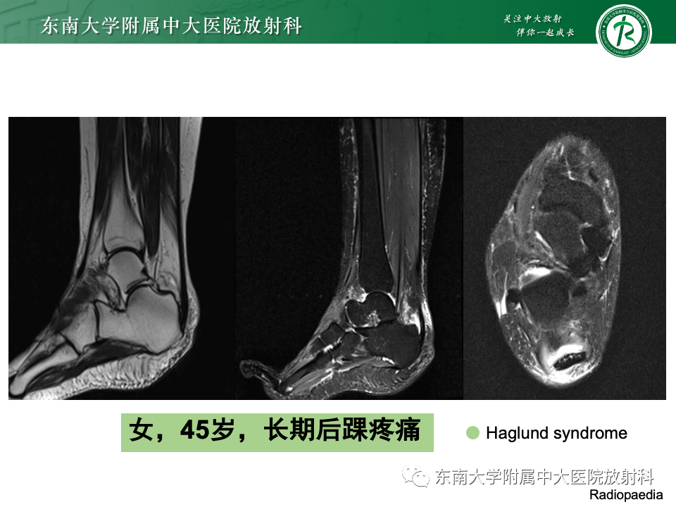影像PPT - 【PPT】Haglund综合征-41 影像PPT - 【PPT】Haglund综合征-41