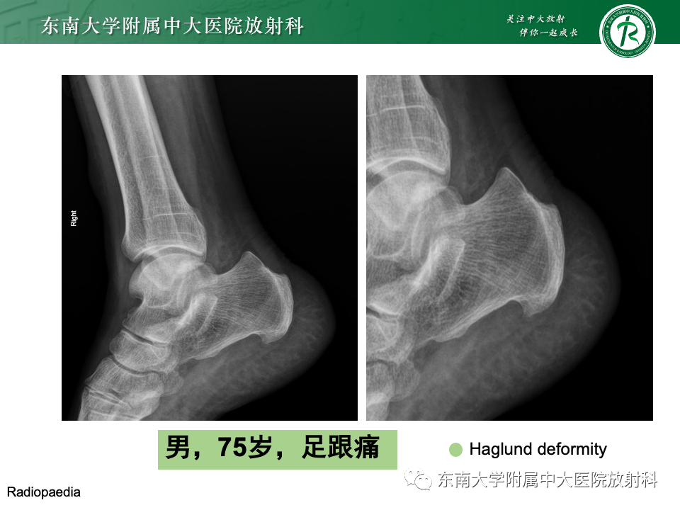 影像PPT - 【PPT】Haglund综合征-42 影像PPT - 【PPT】Haglund综合征-42