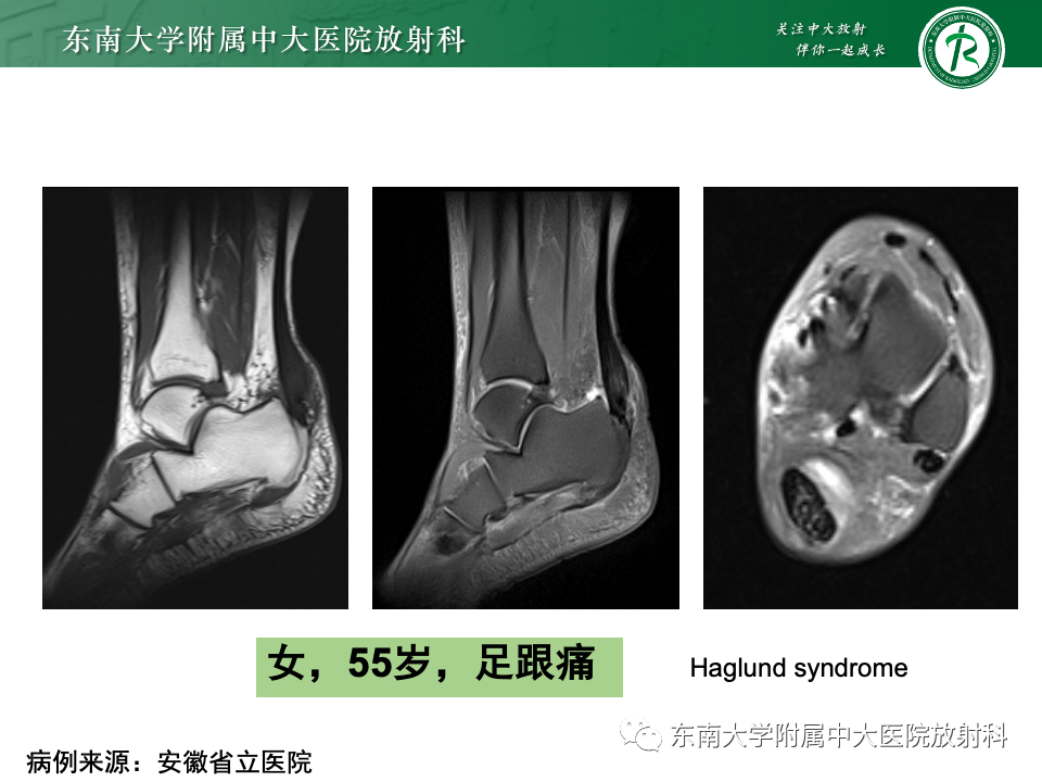 影像PPT - 【PPT】Haglund综合征-43 影像PPT - 【PPT】Haglund综合征-43