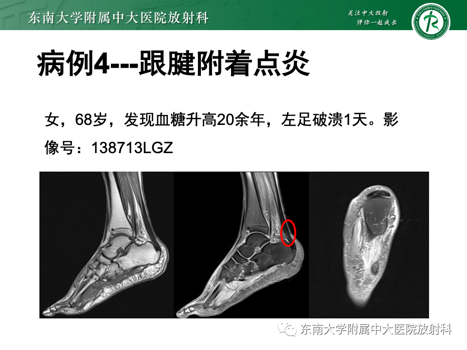 影像PPT - 【PPT】Haglund综合征-45 影像PPT - 【PPT】Haglund综合征-45