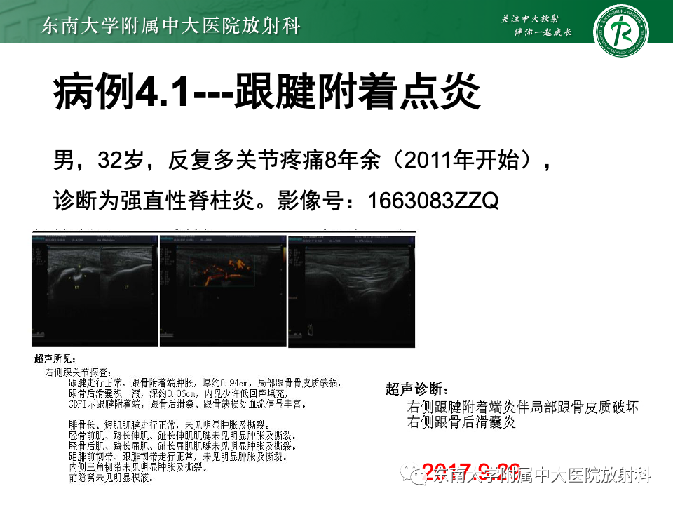 影像PPT - 【PPT】Haglund综合征-46 影像PPT - 【PPT】Haglund综合征-46