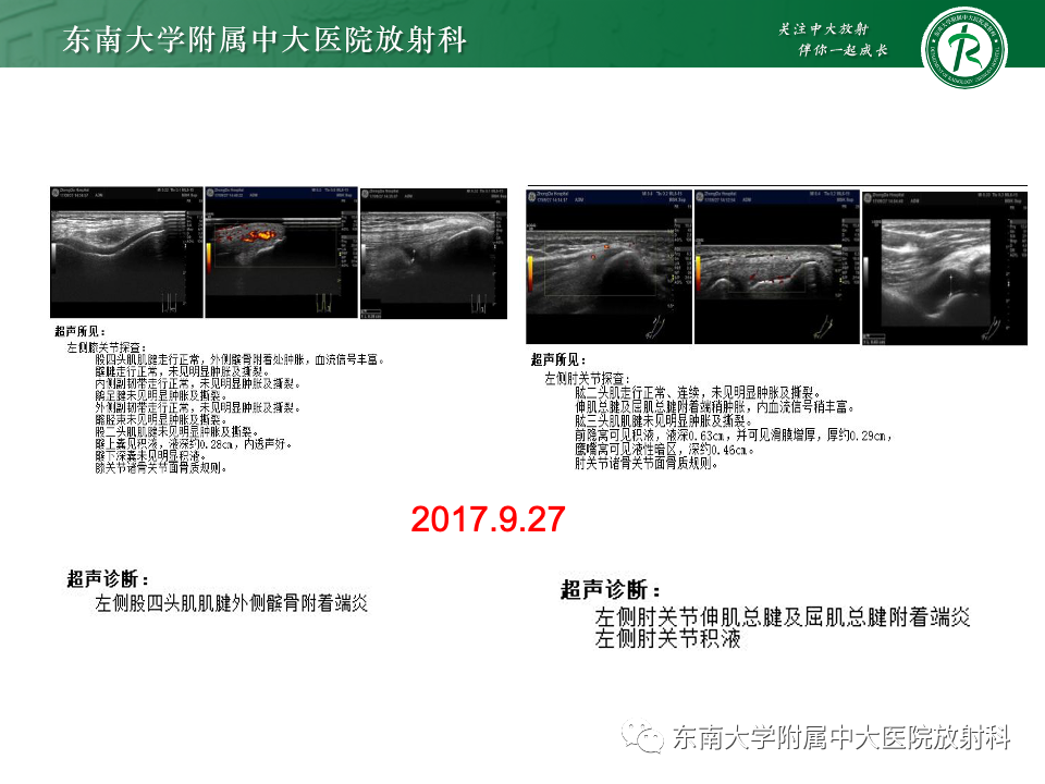 影像PPT - 【PPT】Haglund综合征-47 影像PPT - 【PPT】Haglund综合征-47
