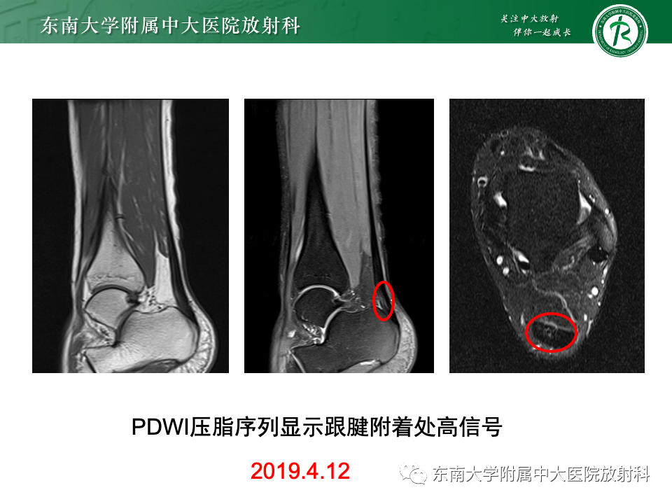 影像PPT - 【PPT】Haglund综合征-48 影像PPT - 【PPT】Haglund综合征-48