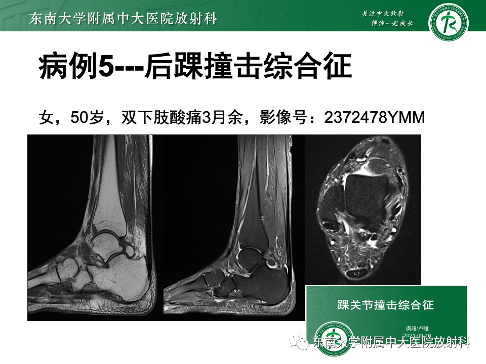 影像PPT - 【PPT】Haglund综合征-49 影像PPT - 【PPT】Haglund综合征-49