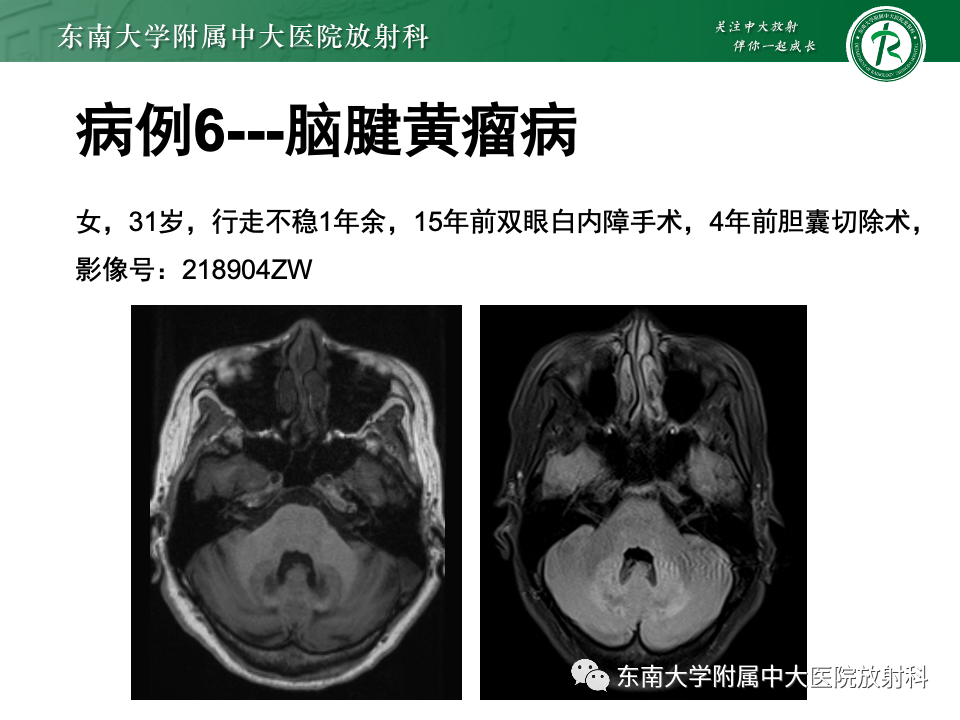 影像PPT - 【PPT】Haglund综合征-50 影像PPT - 【PPT】Haglund综合征-50