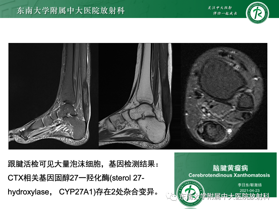 影像PPT - 【PPT】Haglund综合征-51 影像PPT - 【PPT】Haglund综合征-51