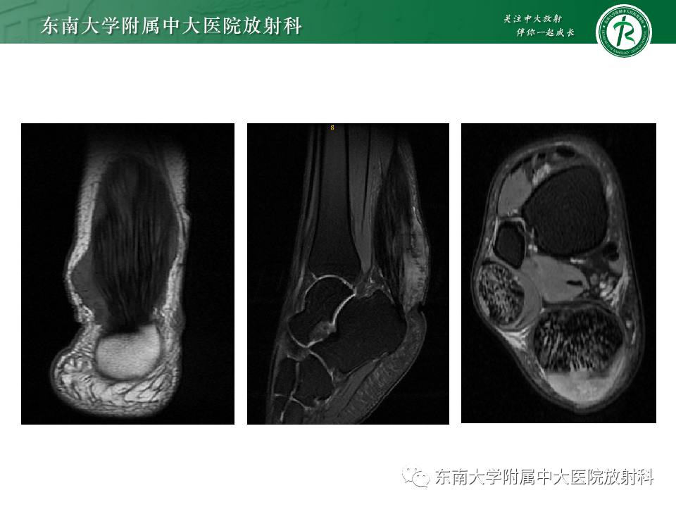 影像PPT - 【PPT】Haglund综合征-53 影像PPT - 【PPT】Haglund综合征-53