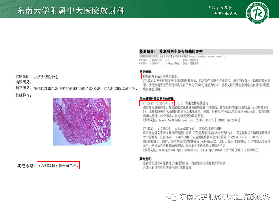 影像PPT - 【PPT】Haglund综合征-54 影像PPT - 【PPT】Haglund综合征-54