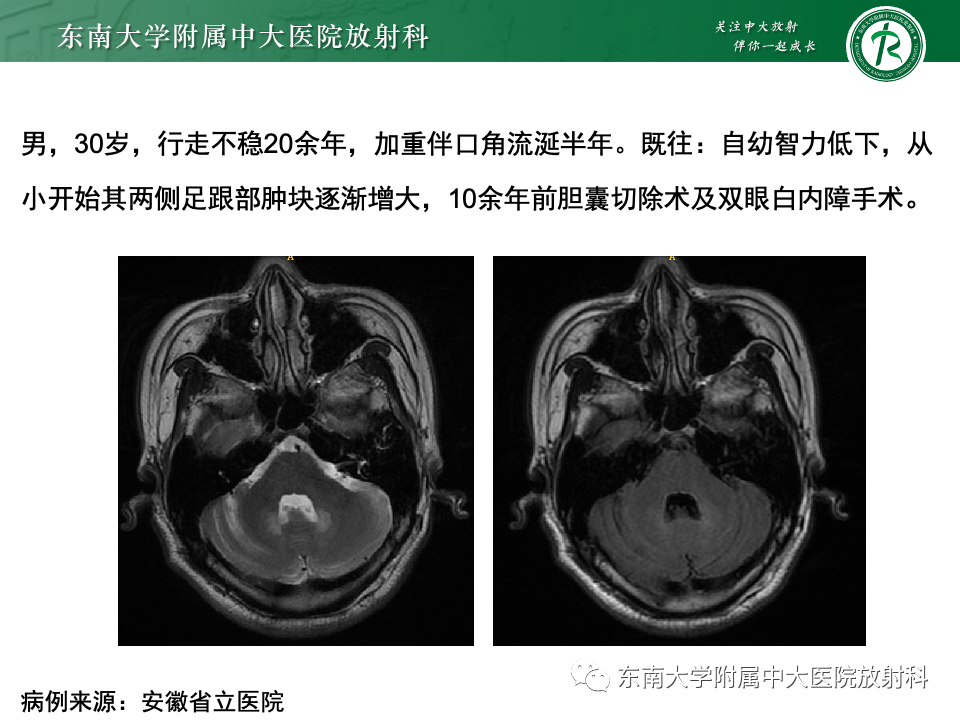 影像PPT - 【PPT】Haglund综合征-52 影像PPT - 【PPT】Haglund综合征-52