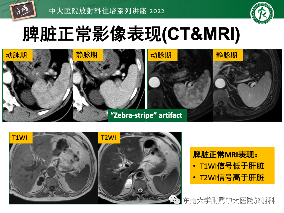 影像PPT - 【PPT】脾脏占位性病变的影像分析-5