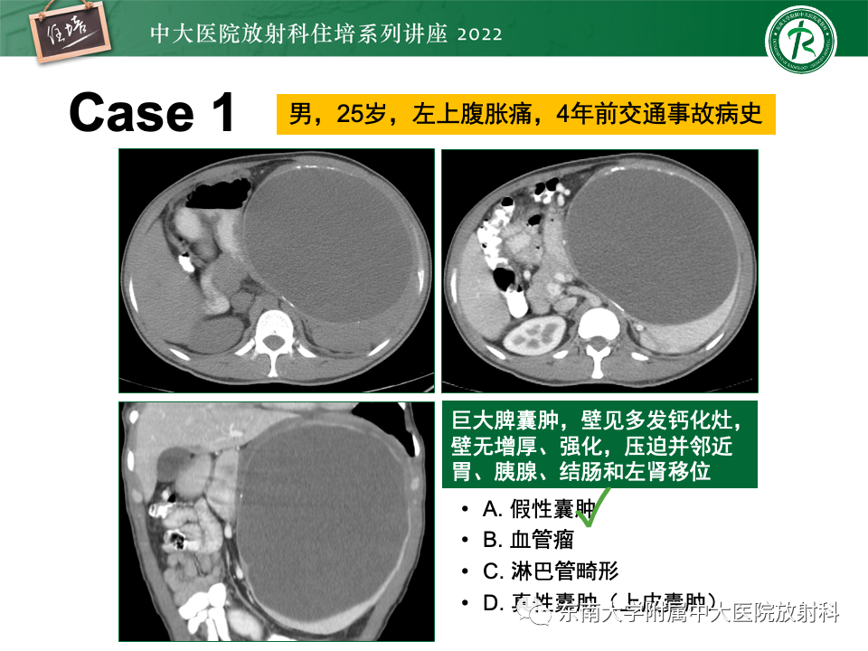 影像PPT - 【PPT】脾脏占位性病变的影像分析-10