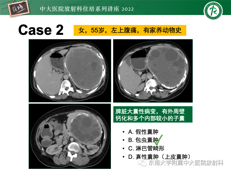 影像PPT - 【PPT】脾脏占位性病变的影像分析-14
