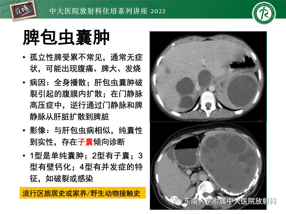 影像PPT - 【PPT】脾脏占位性病变的影像分析-15