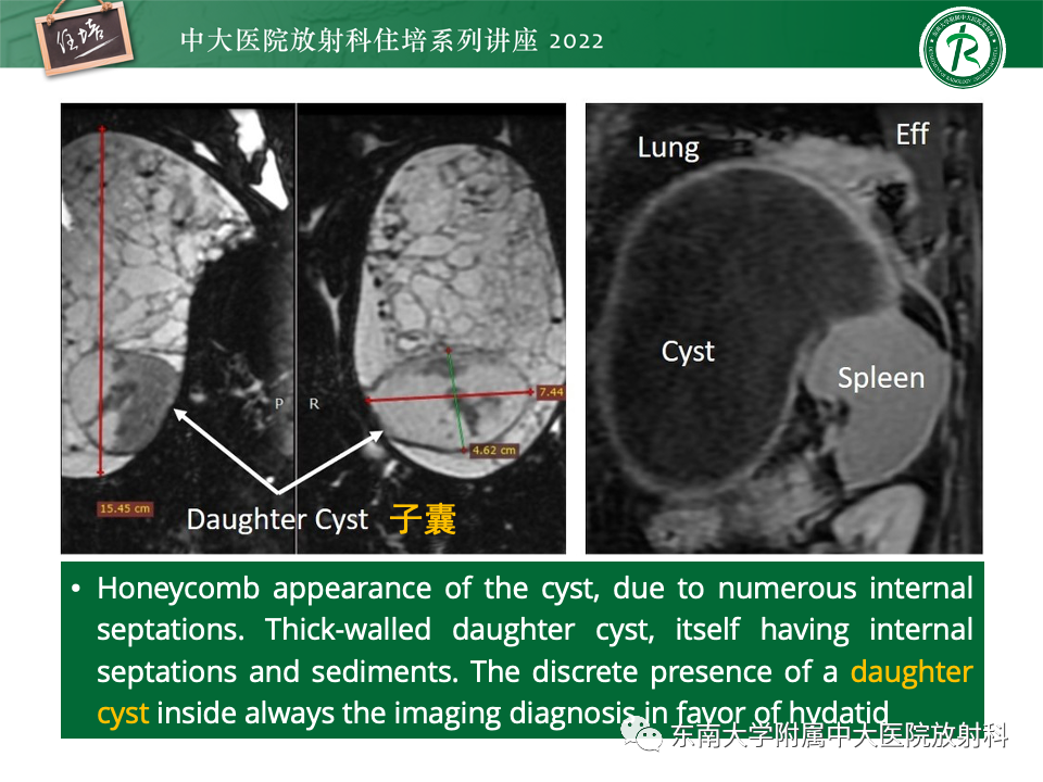 影像PPT - 【PPT】脾脏占位性病变的影像分析-17