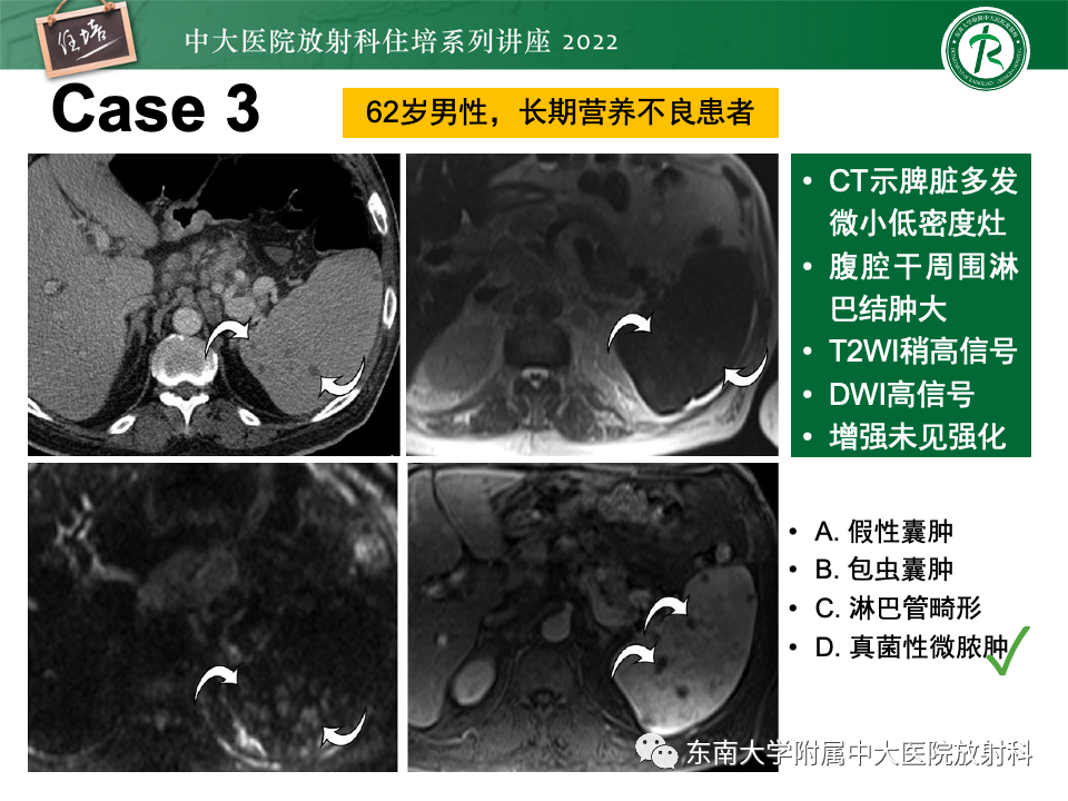 影像PPT - 【PPT】脾脏占位性病变的影像分析-18