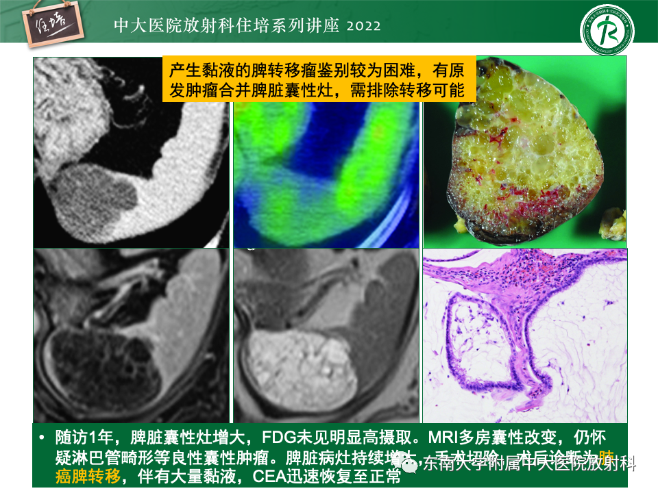 影像PPT - 【PPT】脾脏占位性病变的影像分析-21