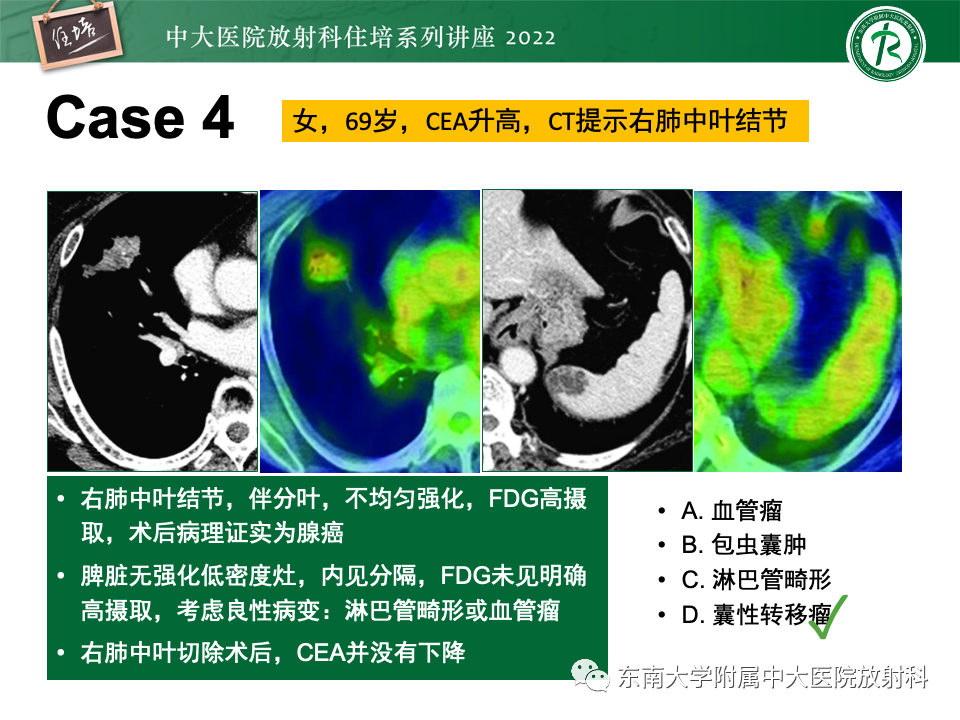 影像PPT - 【PPT】脾脏占位性病变的影像分析-20