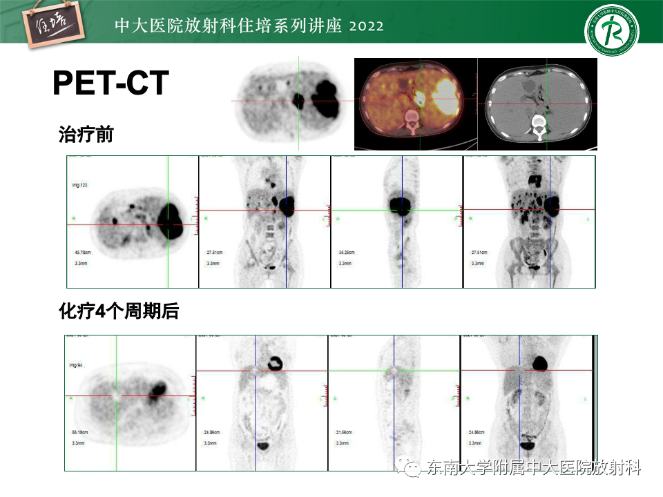 影像PPT - 【PPT】脾脏占位性病变的影像分析-28