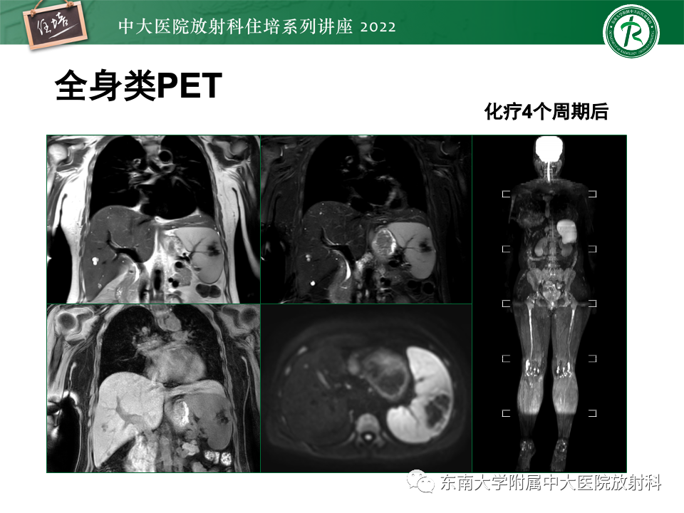 影像PPT - 【PPT】脾脏占位性病变的影像分析-29