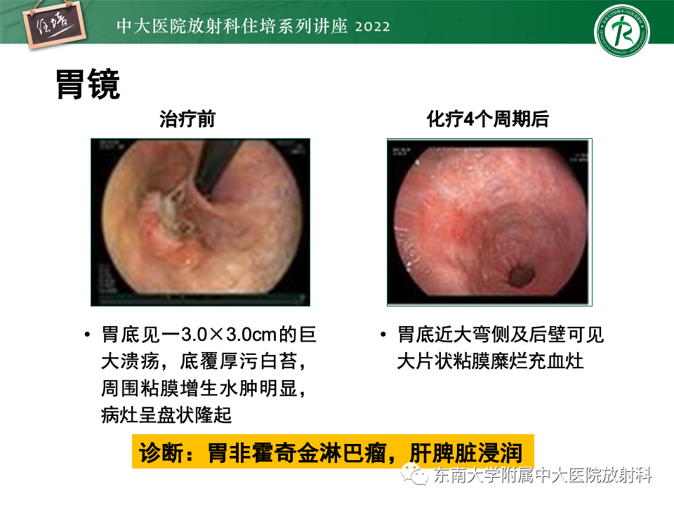 影像PPT - 【PPT】脾脏占位性病变的影像分析-30