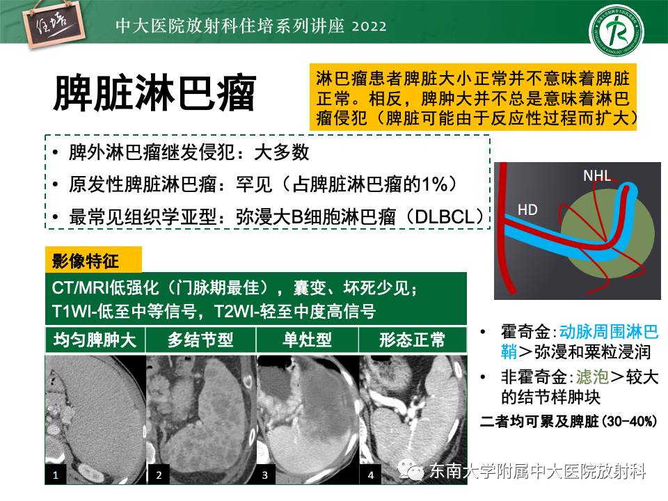 影像PPT - 【PPT】脾脏占位性病变的影像分析-31