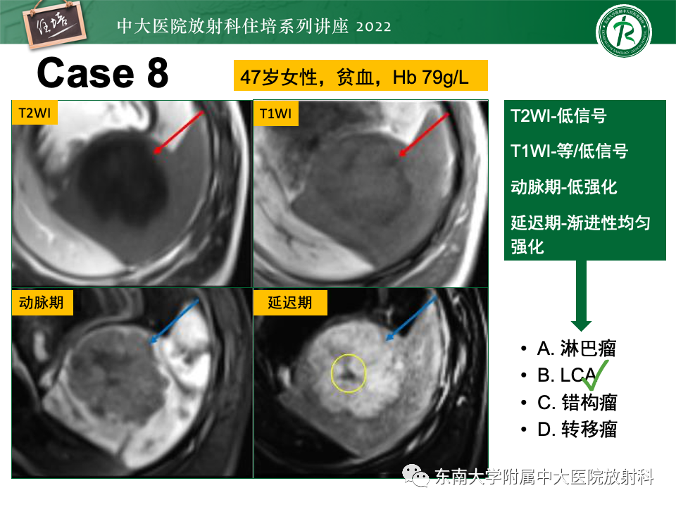 影像PPT - 【PPT】脾脏占位性病变的影像分析-39