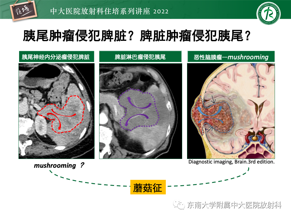 影像PPT - 【PPT】脾脏占位性病变的影像分析-46