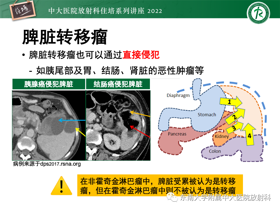 影像PPT - 【PPT】脾脏占位性病变的影像分析-48