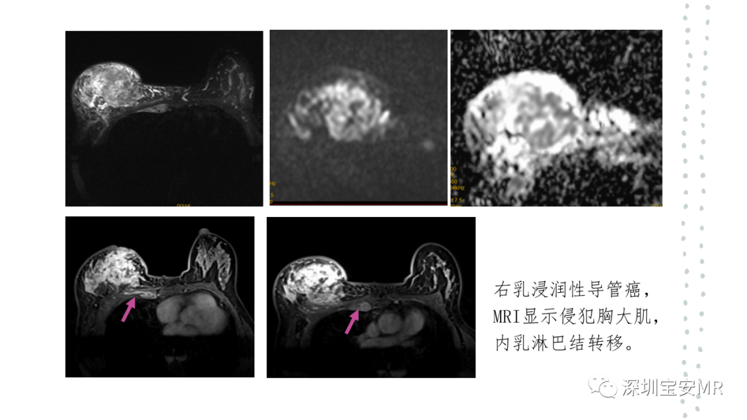 影像PPT - 【PPT】乳腺磁共振科普-3