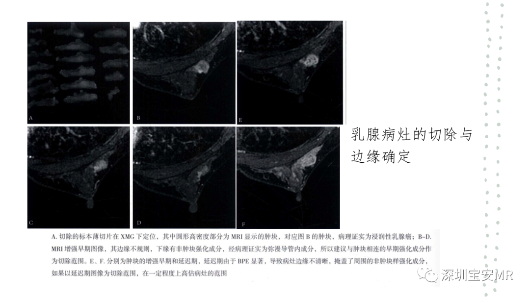 影像PPT - 【PPT】乳腺磁共振科普-5