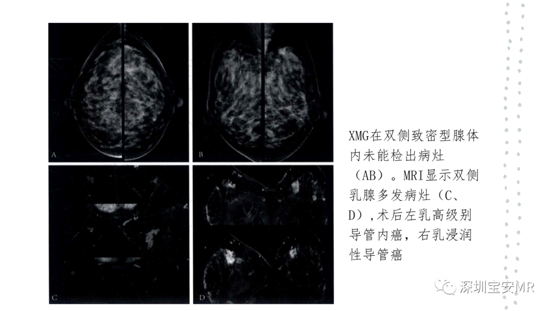 影像PPT - 【PPT】乳腺磁共振科普-4