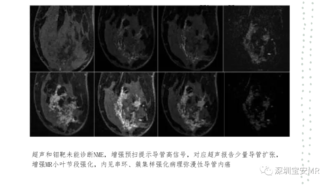 影像PPT - 【PPT】乳腺磁共振科普-10