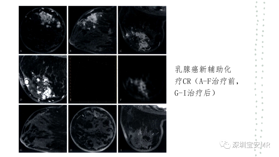影像PPT - 【PPT】乳腺磁共振科普-6