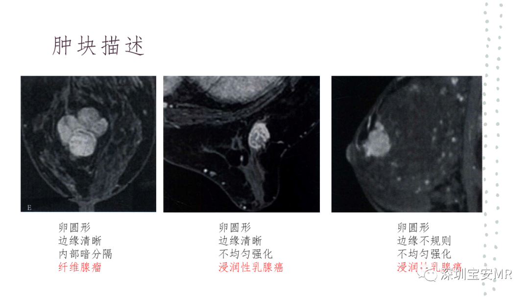 影像PPT - 【PPT】乳腺磁共振科普-16