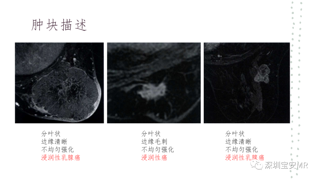影像PPT - 【PPT】乳腺磁共振科普-17