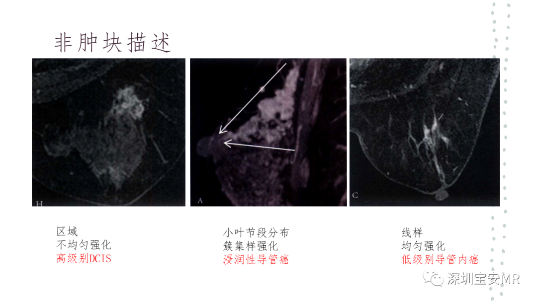 影像PPT - 【PPT】乳腺磁共振科普-18