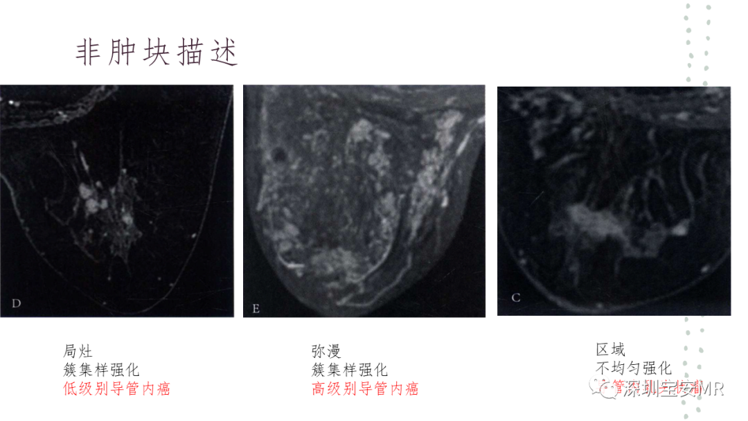 影像PPT - 【PPT】乳腺磁共振科普-19
