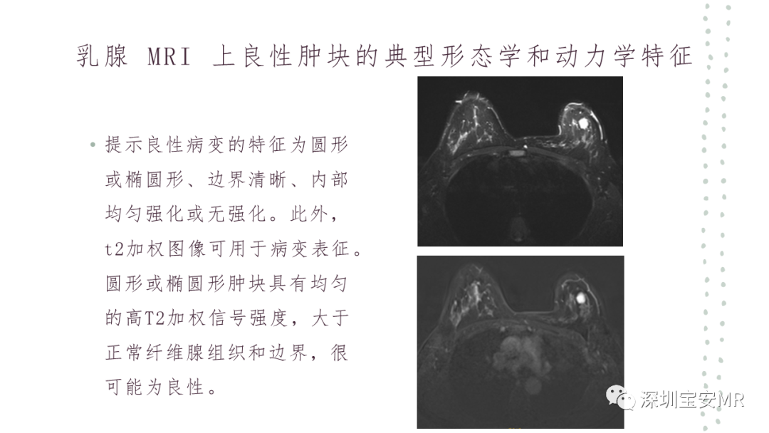 影像PPT - 【PPT】乳腺磁共振科普-22