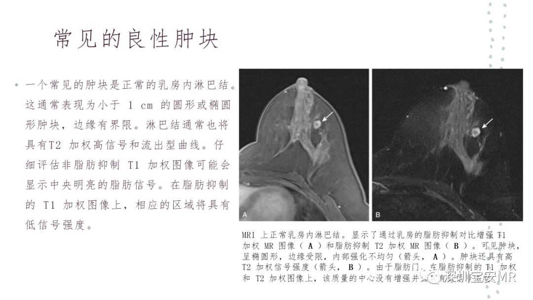 影像PPT - 【PPT】乳腺磁共振科普-23