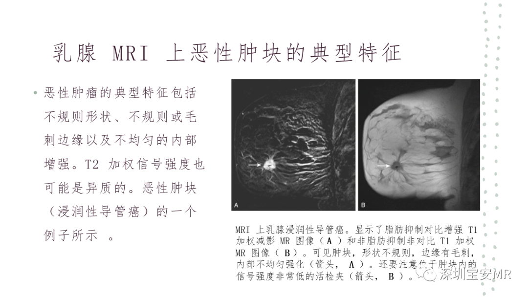 影像PPT - 【PPT】乳腺磁共振科普-25