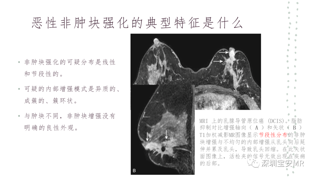 影像PPT - 【PPT】乳腺磁共振科普-27